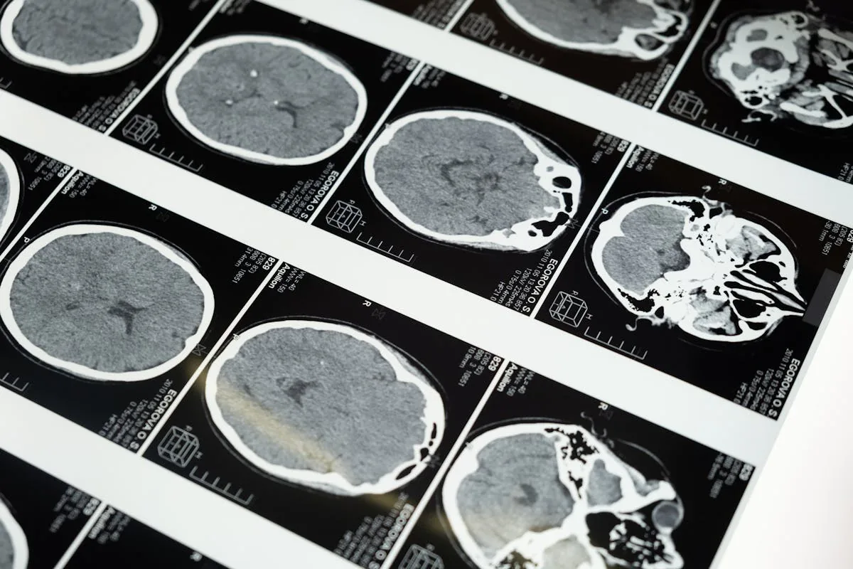 HBOT for Concussion Recovery: What the Evidence Says